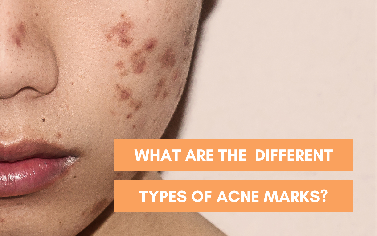 What are Different Types of Acne Scars? | InviCible Skincare